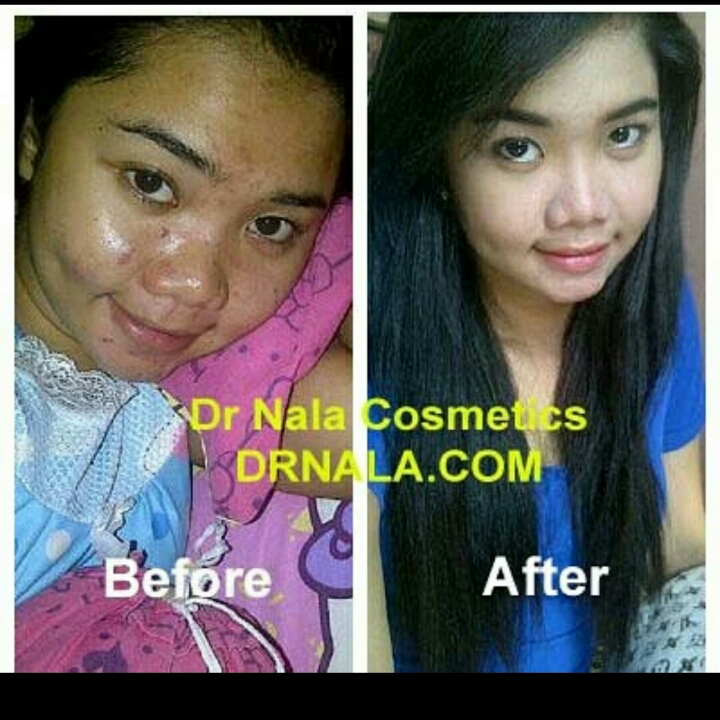 Cream Pembersih Jerawat Dr Nala 4 Series Acne 3