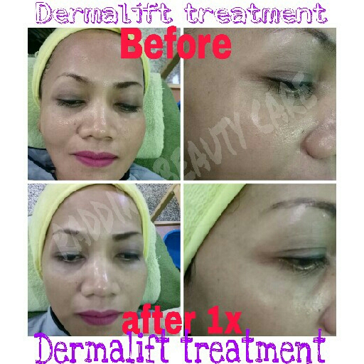 Dermalift Treatment 2