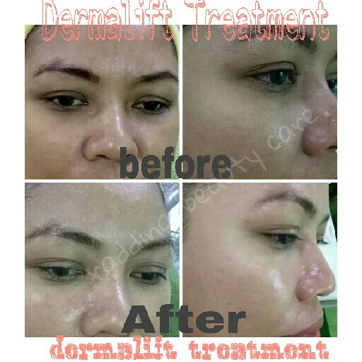 Dermalift Treatment 3