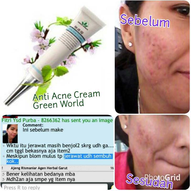 Green World Anti Acne Cream Untuk Mengurangi Jerawat 5