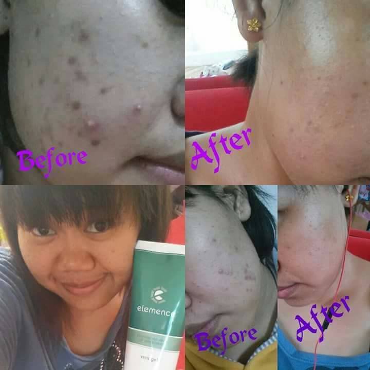 Synergy Elemence Vera Gel Original Utk Kulit Sensitif, Kering, Jerawat 3