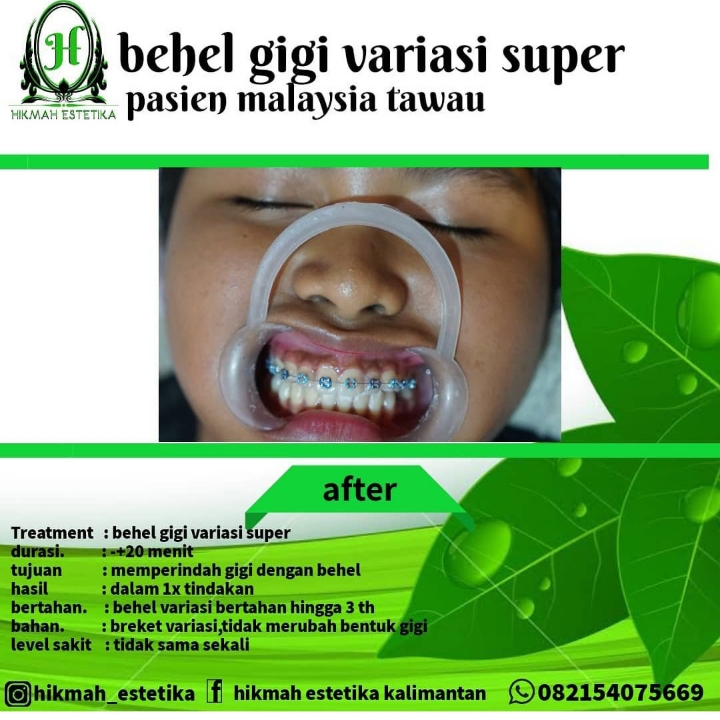 Behel Gigi Variasi 2