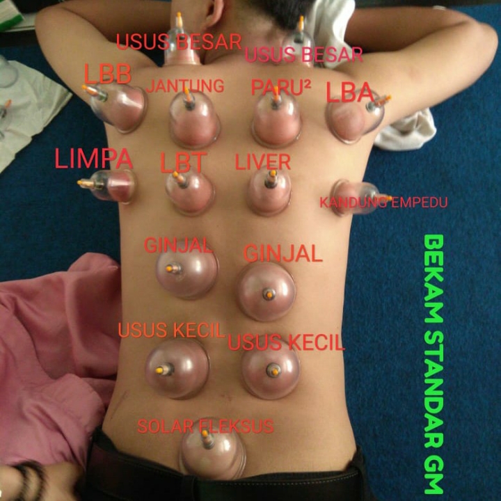 CUPPING