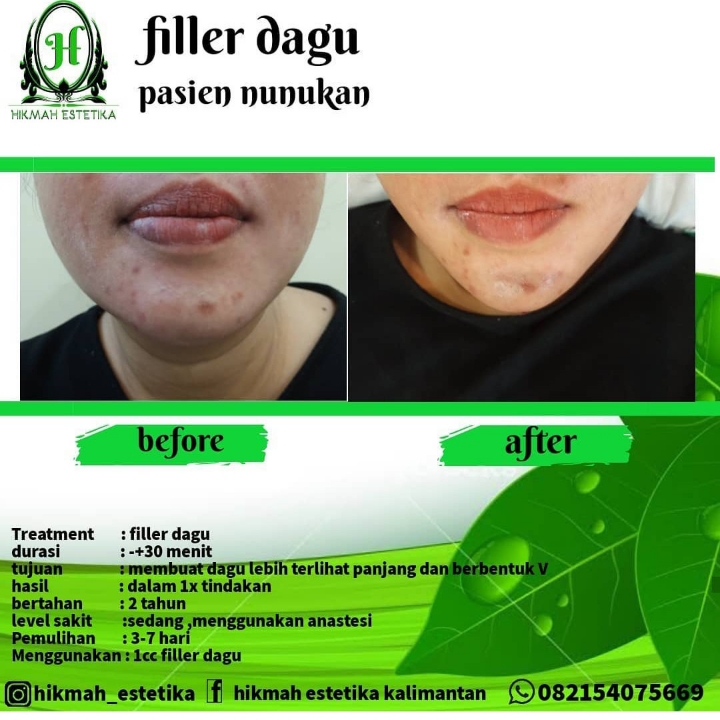 Filler Dagu 2