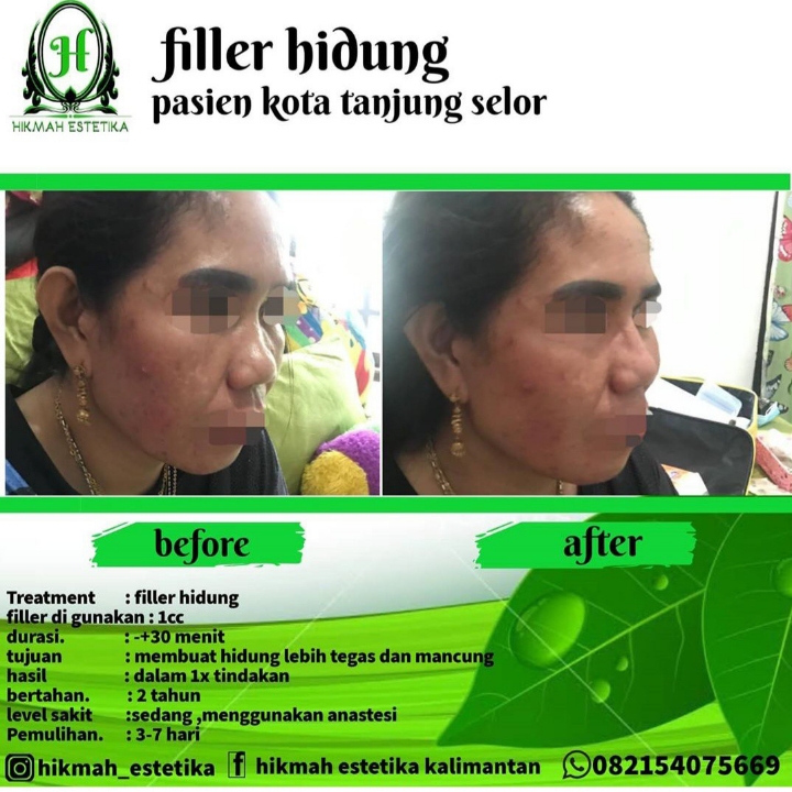 Filler Hidung