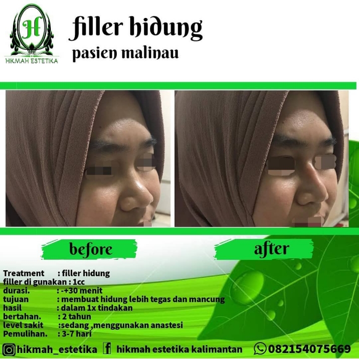 Filler Hidung 2