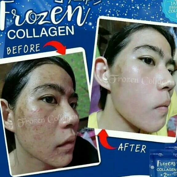 Frozen Collagen 2