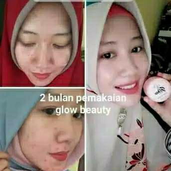 Glow beauty paket acne kinclong 2