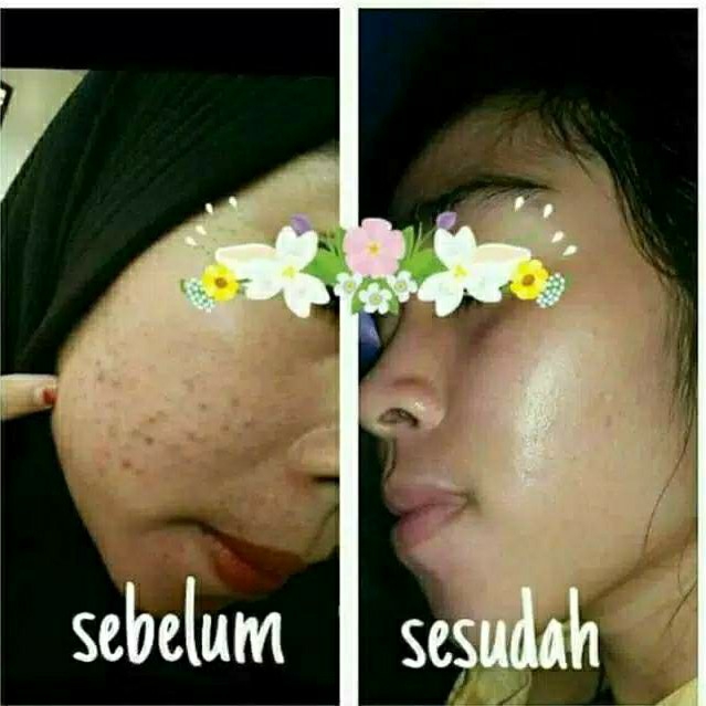 Melasma Acne Serum Penyembuh Jerawat 3