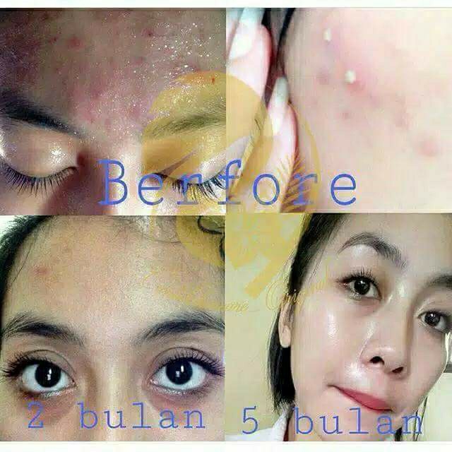 Melasma Acne Serum Penyembuh Jerawat 4