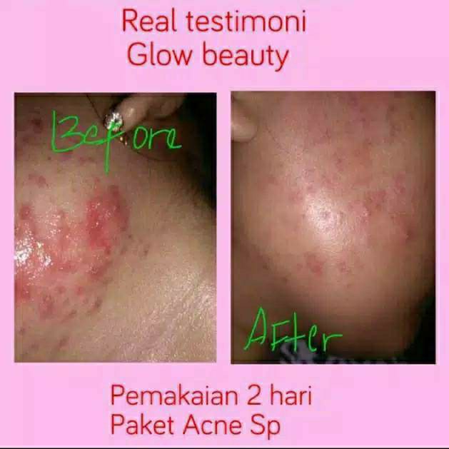 Melasma Acne Serum Penyembuh Jerawat 5