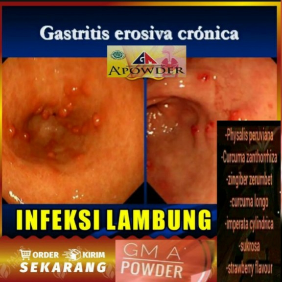 Obat Herbal Lambung Kronis 2