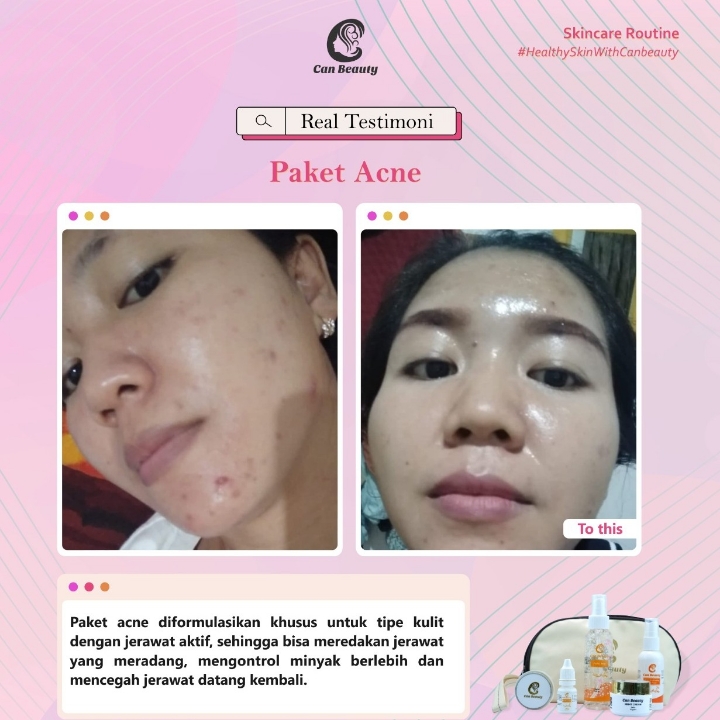 Paket Acne Can Beauty 2