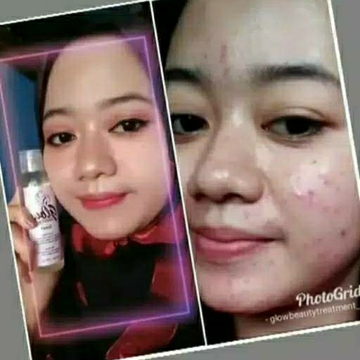 Paket acne kinclong spsial glow beauty 4