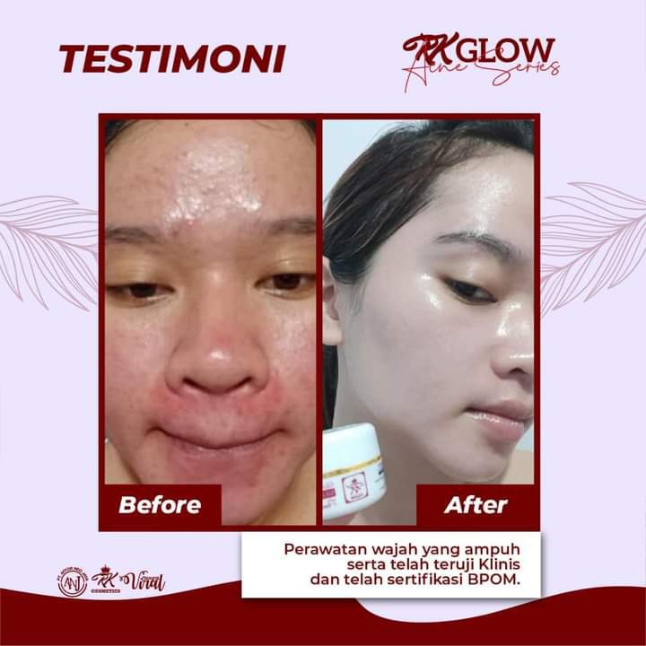 RK Glow Paket Acne