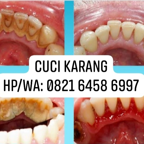 Scaling Cuci Karang Gigi