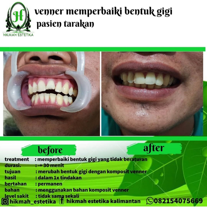 Venner Gigi Patah  2